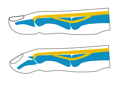 Avulsion of the part of the distal phalanx to which the tendon is attached, a finger fracture
