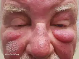 Morbihan disease