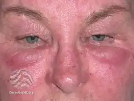 Morbihan disease