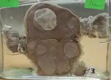 Multiple uterine leiomyoma with calcification