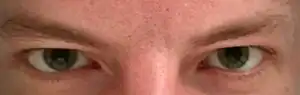 Patient with mydriasis due to usage of LSD