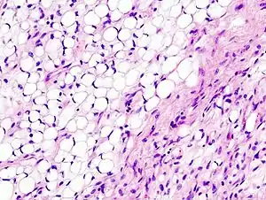Fig. 3 Lower-power micrograph of myxoid liposarcoma tumor