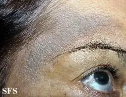Nevus of Ota