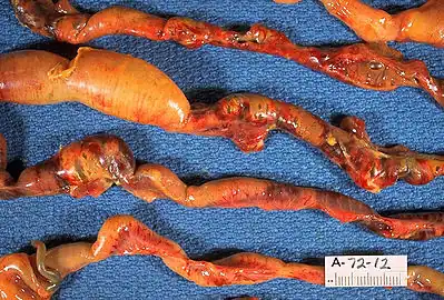 Closeup of intestine of infant showing necrosis and pneumatosis intestinalis. Autopsy.