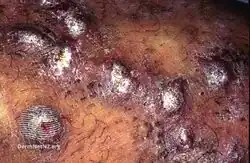 Prurigo nodularis