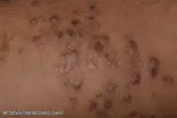 Prurigo nodularis