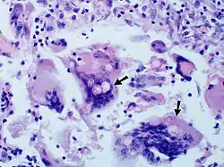 Large yeast-like fungi seen within giant cells at arrows.Budding yeasts in cytoplasm of giant cells at arrows. Broad-based budding and double contoured cell wall seen in the giant cell in the center is characteristic of Blastomyces dermatitidis.