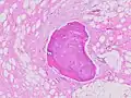 Fig. 1 Micrograph of bone formation in a liposarcoma tumor