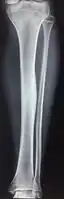 1 a. Osteoid osteoma (front view) showing cortical thickening mid-tibia