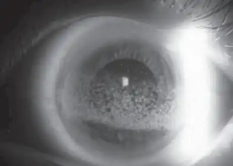 Band keratopathy (in setting of intraocular inflammation and elevated serum calcium).
