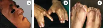 Apert syndrome a) face b) hands c) feet