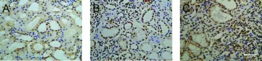 a) Apoptotic cell death in IgA nephropathy b,c) scattered distribution in IgA nephropathy.