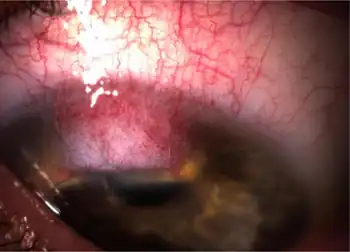 Keratoconjunctivitis