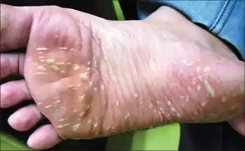 Pustular bacterid