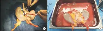 a) Horseshoe kidney showed 5 arteries (white arrows) and 2 veins (white arrows) b) 2 arteries and 1 vein on each side