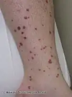 Palpable purpura