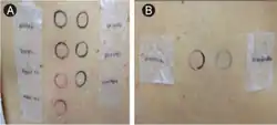 Patch test to anti-histamines