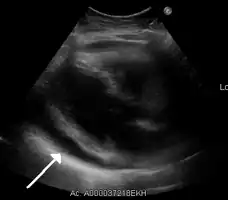 A pericardial effusion due to pericarditis