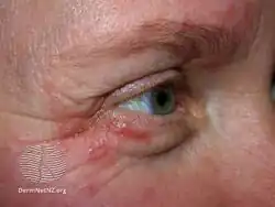 Perioral dermatitis