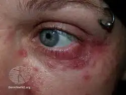 Perioral dermatitis