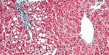 Micrograph of periportal hepatic steatosis, as may be seen due to steroid use, trichrome stain