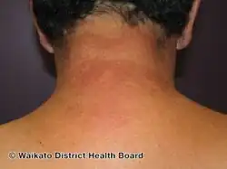 Photosensitivity