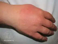 Photosensitivity