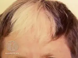 Piebaldism
