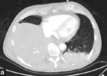 CT pneumonia