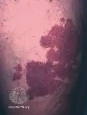 Port-wine stain