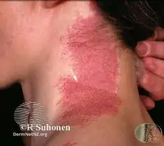 Port wine stain