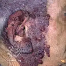 Port-wine stain