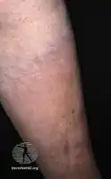 Pretibial myxoedema in Graves disease