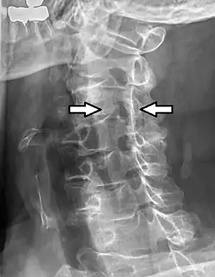Projectional radiograph of a man presenting with pain by the nape and left shoulder, showing a stenosis of the left intervertebral foramen of cervical spinal nerve 4 due to age-related degenerative changes, corresponding with the affected dermatome