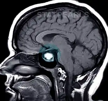 Prolactinoma on MRI