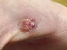 Pyogenic granuloma