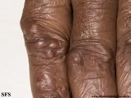 Rheumatoid nodules