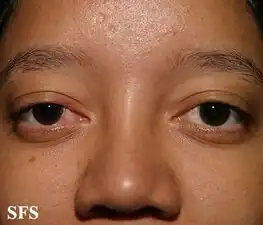 Ocular rosacea