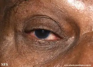 Ocular rosacea