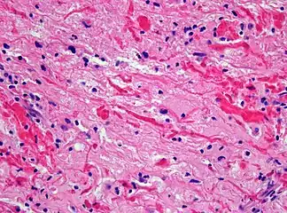 Histopathology of Rosenthal-fibres. H&E staining showing these elongated eosinophilic structures in the case of pilocytic astrocytoma.