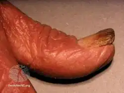 Sézary syndrome