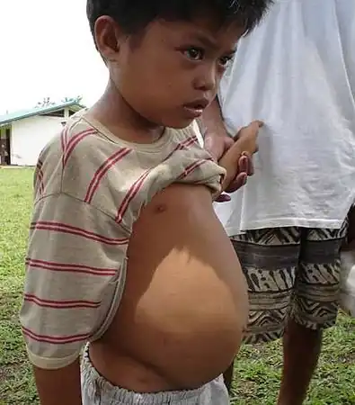 11-year-old boy with abdominal fluid and portal hypertension due to schistosomiasis (Agusan del Sur, Philippines)