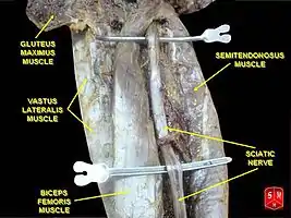 Sciatic nerve.