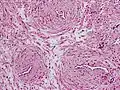 Angioleiomyoma, smooth muscles encircling dilatated blood vessels
