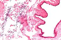 Micrograph of a spermatocele.  The characteristic sperm are present (black dots - left of image). H&E stain.