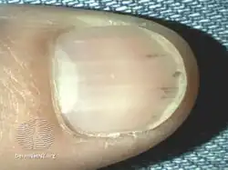 Splinter hemorrhage