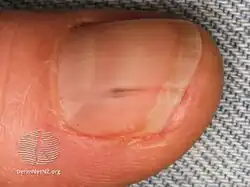 Splinter hemorrhage