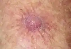 Squamous cell carcinoma, left ventral forearm