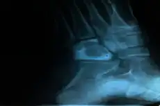 GAS bone
