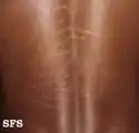 Striae